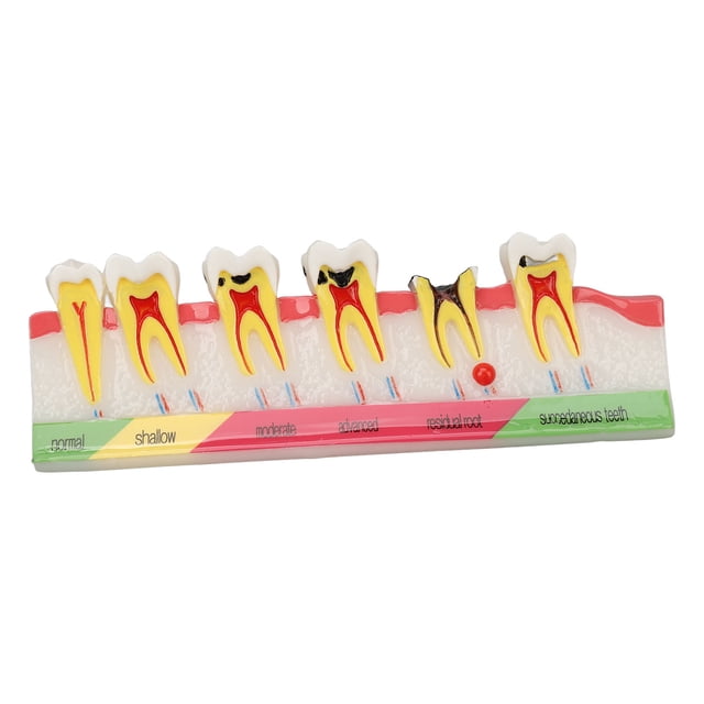 Modelo de caries dental, 6 etapas diferentes, modelo de exhibición de dientes cariados de resina