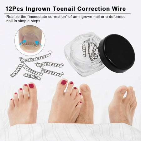 12Pcs Ingrown Toenail Correction Wire Fixer Ingrown Toe Nail Corrector Pedicure Treatment Foot Care