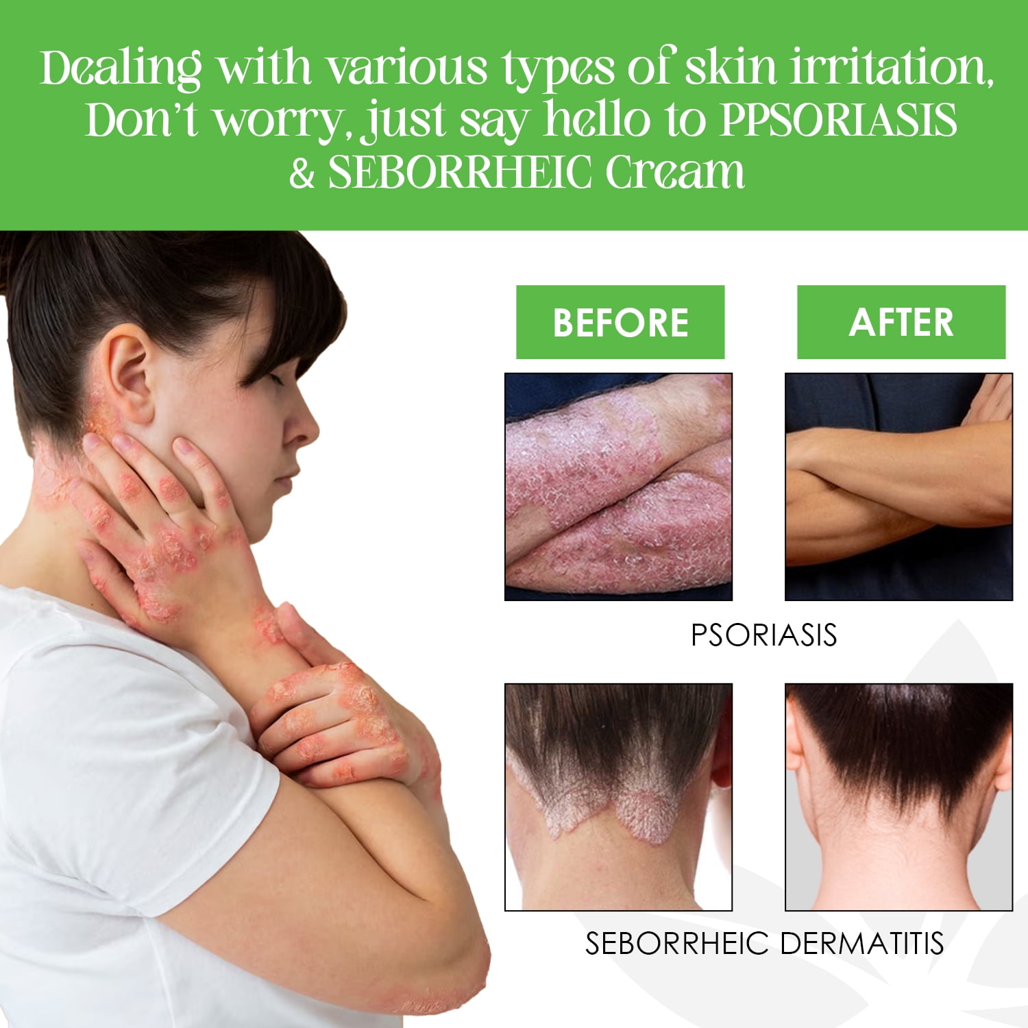 Dermveda Psoriasis & Seborrheic Dermatitis Cream, Natural Anti-Fungal Ointment, Fragrance-Free, 2 fl oz