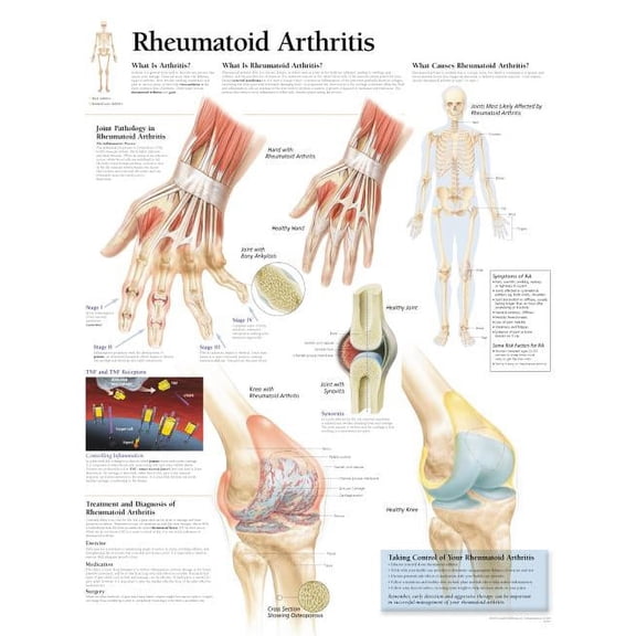 Rheumatoid Arthritis : Wall Chart (Wallchart)