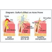 Sulfur Soap Dermatologist Approved 60 years | Joesoef Skin Care Sulfur Soap