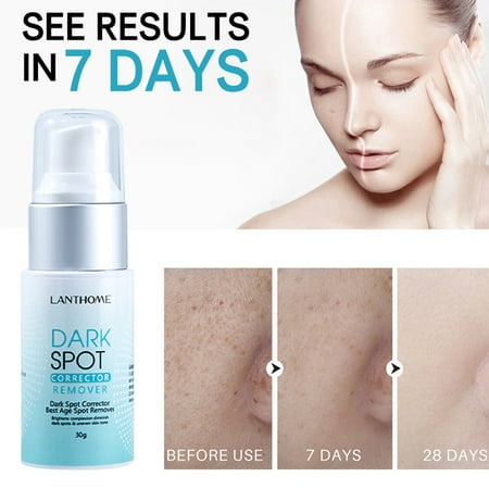 Alaparte Dark Remover For Face:Dark Corrector Serum Sun Age Spots Freckles Melasma Brown Remover For Women&Men 30ml,Dermatologist Recommendation