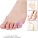 thumbnail image 5 of ZHAOCHENG Férula para dedo meñique, separador de gel para dedos, enderezador para dedo meñique (morado), paquete de 10, 5 of 5