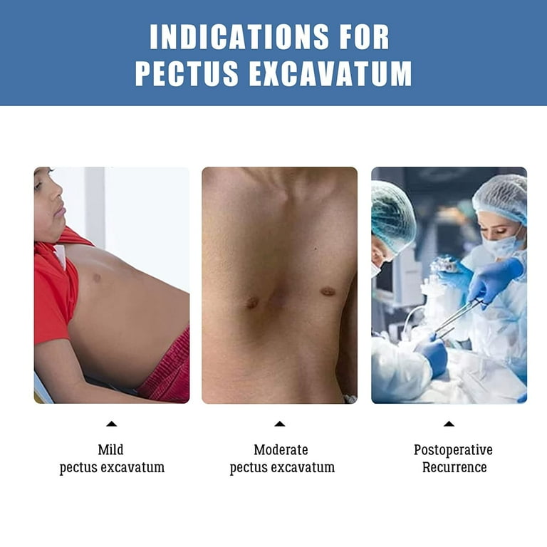 Pectus Excavatum Baby