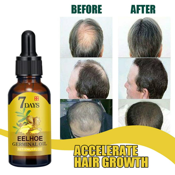 Hair Growth Serum Ginger Hair Regrowth Oil Hair Treatment Products for  Stronger Thicker Longer Hair Regrowth Stop Hair Thinning Hair Loss for Men  Women 