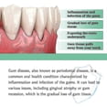 thumbnail image 4 of Gotas de suero reparador de encías rápidamente para aliviar la retracción de las encías, el cuidado de las ampollas periodontales, blanquear los dientes y eliminar el dolor de muelas amarillas, pasta, 4 of 5