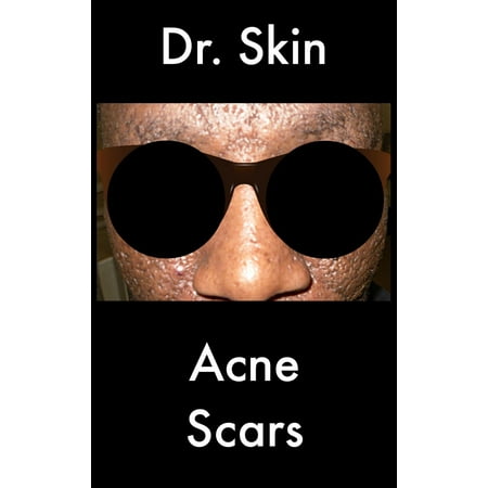 Acne Scars - eBook (Best Way To Treat Acne Scars)
