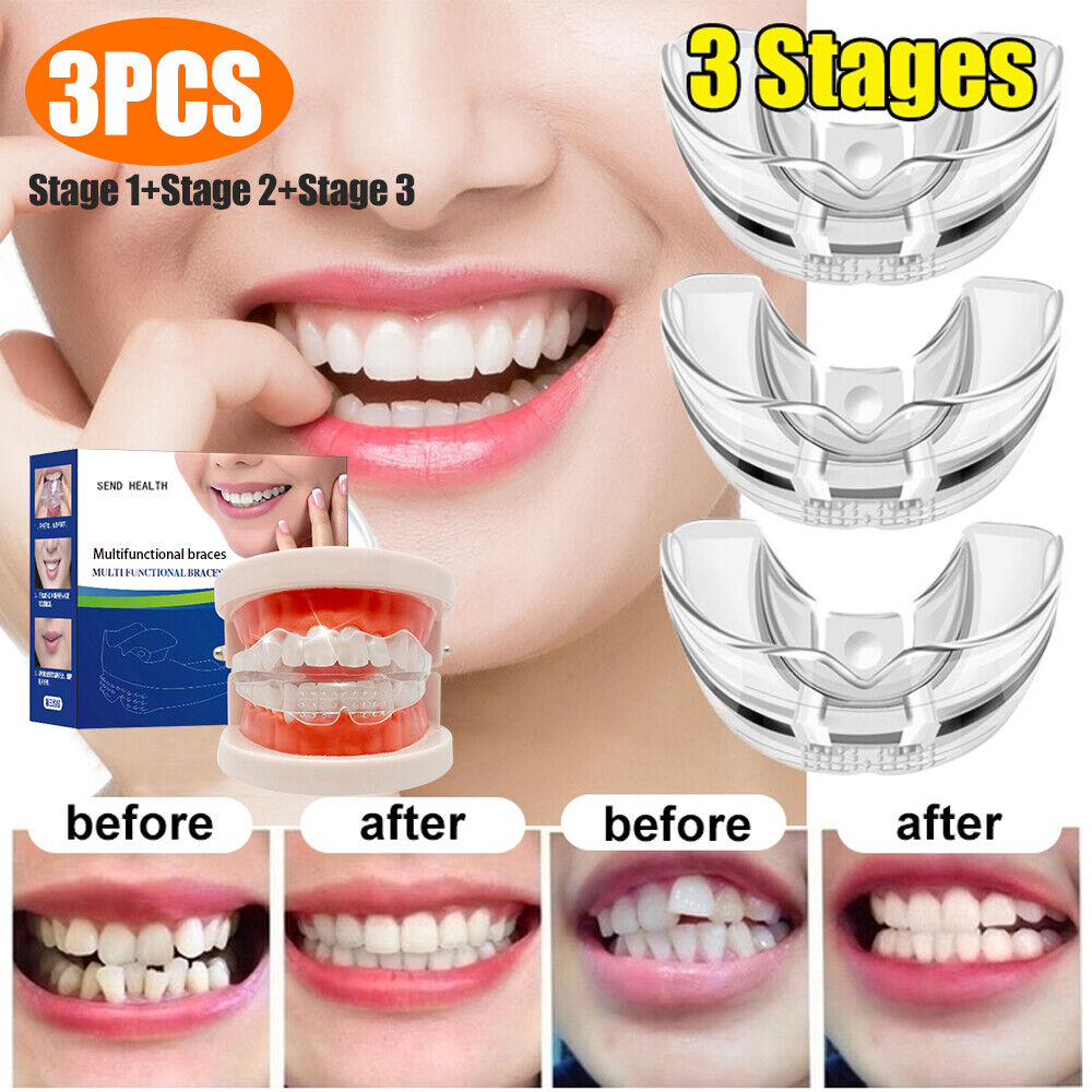 Occkic 3 Stages Dental Orthodontic Teeth Corrector Braces Tooth