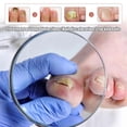 thumbnail image 2 of Tratamiento de hongos en las uñas de los pies Solución antimicótica Reparación de uñas de los pies y las manos, 2 of 5