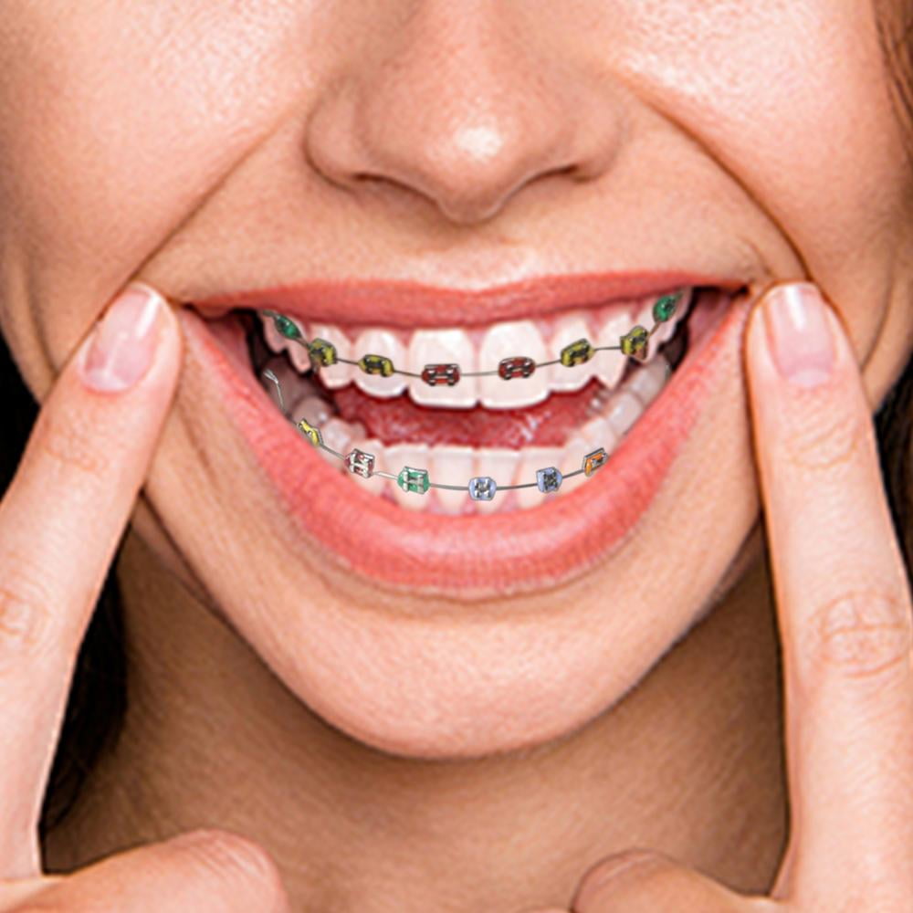 Fake Braces, Kids Fake Braces Lip Protector Colorful Braces Wire, Teeth Braces Wire, Stylish Teeth Cosplay Braces for Dentists, Kids