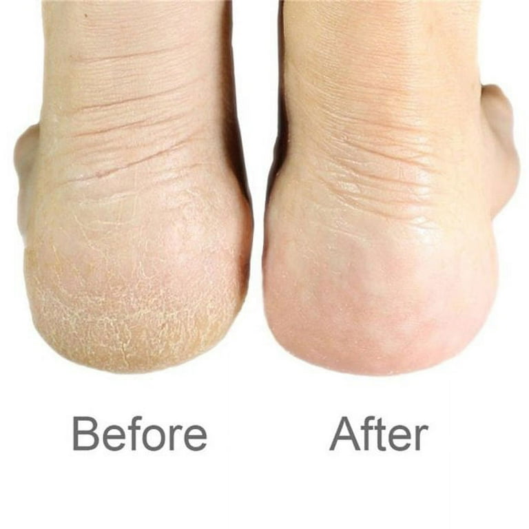 Professional Foot Callus Remover Rasp Scraper Cracked Pedicure Rough Heel  Tools