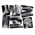 thumbnail image 1 of Broken Bone Compound Fracture X-Rays, 1 of 1