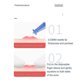 thumbnail image 4 of Herramienta para eliminar puntos negros e imperfecciones (50/100 unidades), aguja desechable profesional para eliminar el acné, removedor de puntos blancos, herramienta extractora de espinillas., 4 of 4