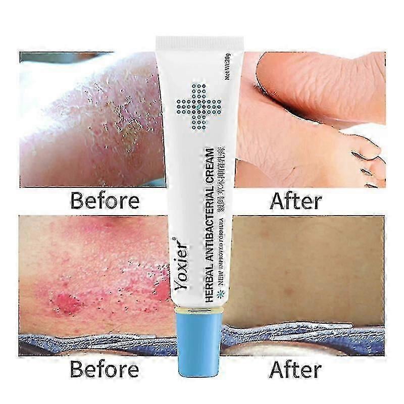 20g Skin Rash Cream Eczema Ointment Anti-Fungal Cream Psoriasis Treatm ...