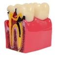 thumbnail image 3 of Axis Scientific Decayed Teeth Comparison Anatomy Model, 6x Life-Size, Human anatomy system miniature, demonstration skill, educational model Includes Product Manual, scientific anatomy model, 3 of 7