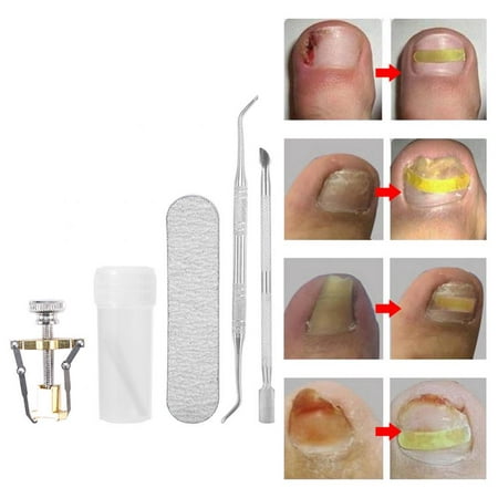 6Pcs/Set Toenail Correction Patch Dead Skin Pliers Ingrown Acronyx Corrector Pedicure Tool Ingrown Toe Nail Fixer Foot Care (Best Home Treatment For Ingrown Toenails)