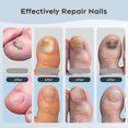 thumbnail image 4 of Nail Fungus Laser Treatment Device for Toenails & Fingernails, Home Use 905nm Infrared Light + 470nm Blue Light for Nail Repair, 4 of 5