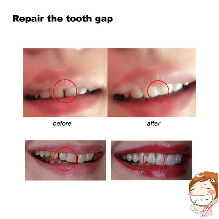 Temporary Tooth Repair Kit For Filling The Missing Broken Tooth And Gaps