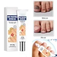 thumbnail image 2 of Crema reparadora de uñas para tratamiento de uñas, potente crema antiinfección para tratamiento de uñas por hongos, esencia reparadora para dedos de los pies, eficaz, 2 of 5