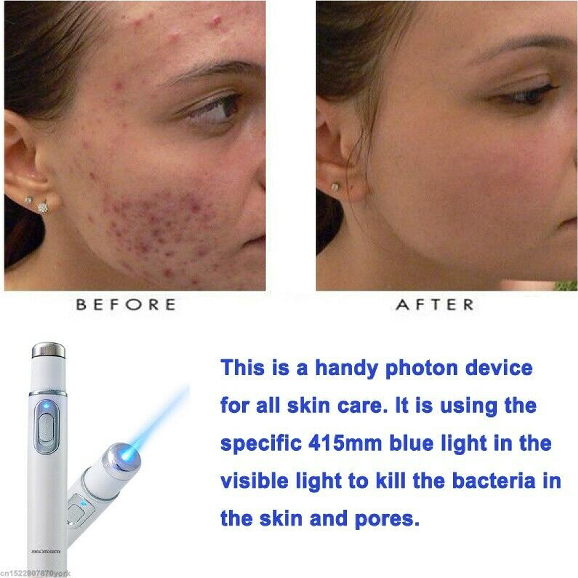 Spider Vein Laser, 1 Pack Blue Light Pen For Veins,acne Laser Pen