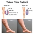 thumbnail image 5 of Set de terapia de luz azul para venas varicosas, crema para venas varicosas y bolígrafo de terapia de luz azul, 5 of 5