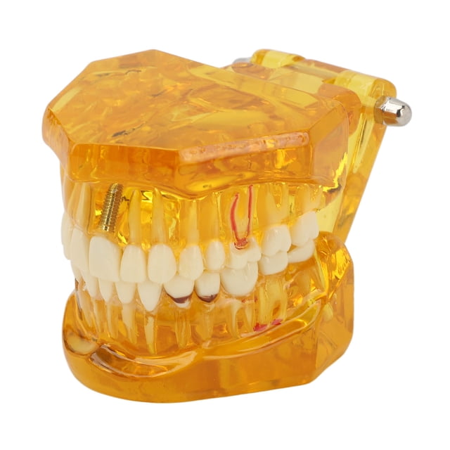Modelo De Dientes Dentales, Modelo Patológico Dental Estructura Clara Modelo De Exhibición De Dientes Educativos Amarillo Transparente