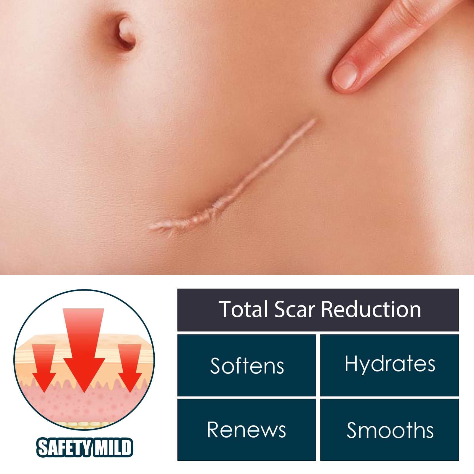 Alvantor Advanced Silicone Gel for Effective Scar Treatment  for both Old and New Scars, 1.69 fl. oz