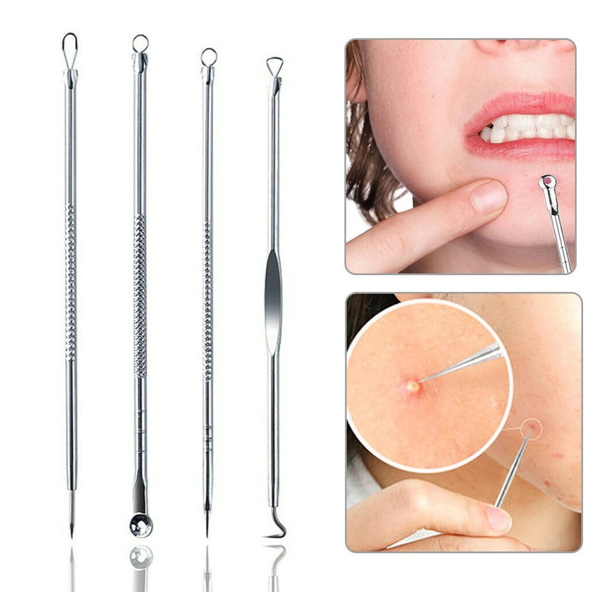 Industrial & Scientific Pimple Suvorna Skinpal s35 Lancet for Whitehead Extractor Approved by