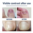 thumbnail image 4 of 50 Uds Pegatinas Corrección Uñas Encarnadas Corrector Uñas Visible, 4 of 6