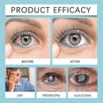 thumbnail image 4 of Presbyopia Vision Care Drops Removal Enhance Eyesight Cataract Cure Relief Eye Pain Blurred Vision Eyeball Fatigue Eye Drops 26s, 4 of 5