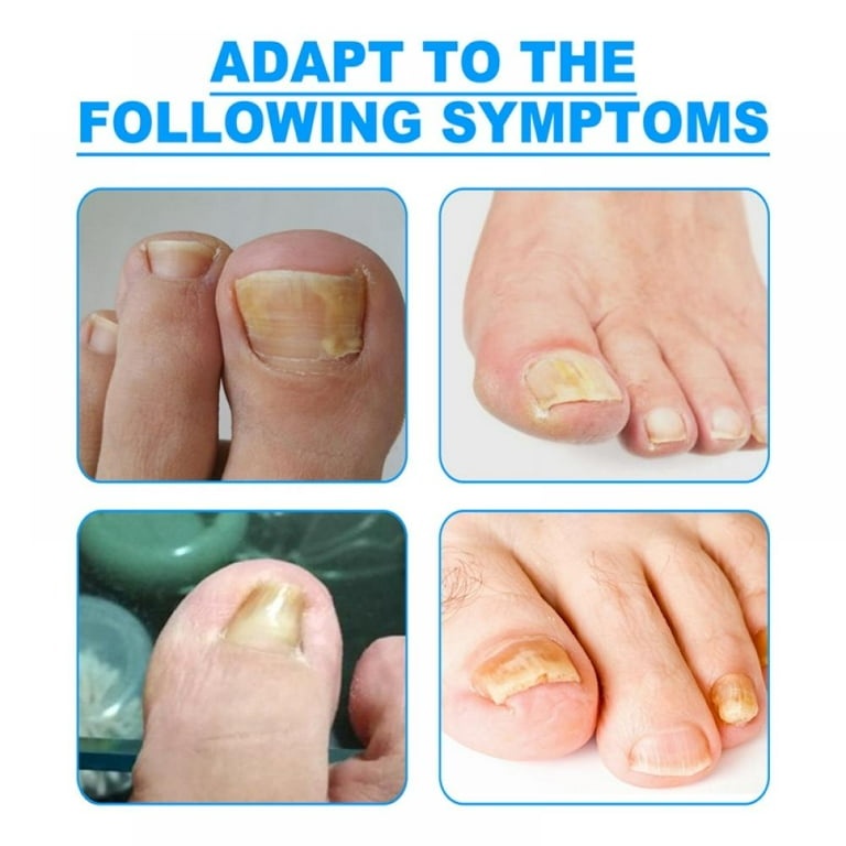 Zaqw 24pcs Ingrown Toenail Correction Bandage Paronychia Treatment Band