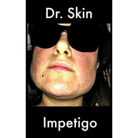 Impetigo - eBook (Best Cure For Impetigo)