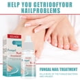 thumbnail image 3 of Nail Fungal Removal Essence 10ml Nail Fungal Removal Liquid Productos para el cuidado de los pies, 3 of 9