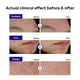 thumbnail image 3 of Blemish Spot Patch Mediheal Derma Clear Madecassoside 132 unidades, 3 of 8