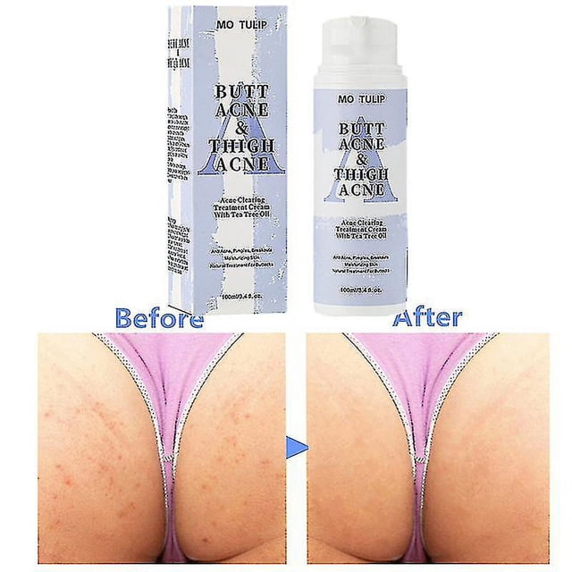 Crema para el tratamiento de manchas de acné YONGSHENG 100ml