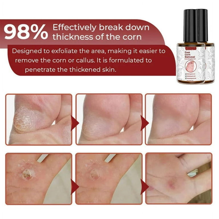 Callus Best Way To Remove A Corn Between Toes Callus Remover Corn