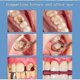 thumbnail image 4 of Quick repair of cavities caries removal of plaque stains rotting whitening yellowing repair teeth whitening, 4 of 4