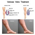 thumbnail image 5 of EELHOE intravenous massage spray relieves pain in veins and leg blood vessels and smoothes earthworm legs Massage Oil1PCS), 5 of 5