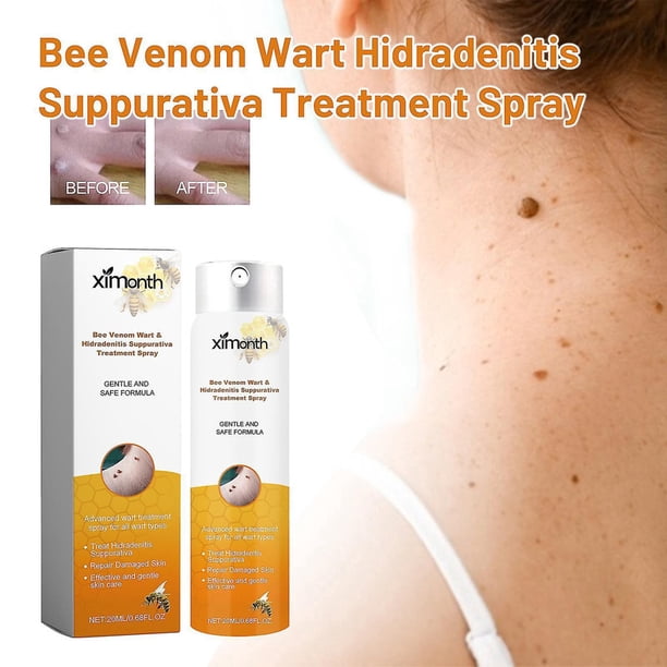 Spray de tratamiento de hidradenitis supurativa de verrugas con veneno de abeja, eliminación de marcas en la piel, eliminador de verrugas con veneno de abeja, congelación de verrugas