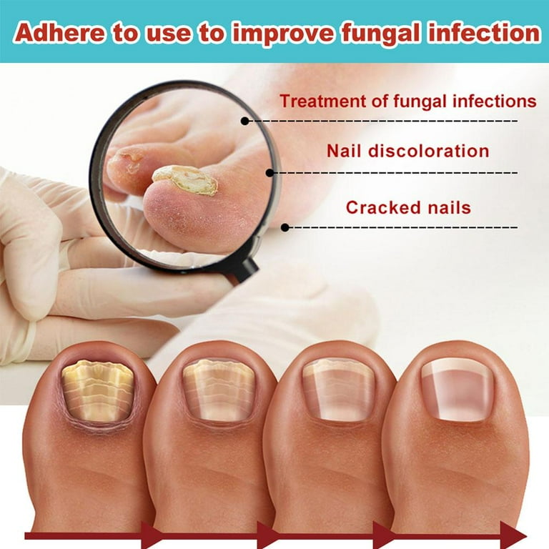 16 Patches Anti Fungal Nail Treatment Toe Fungus Onychomycosis Repair Sticker 3 pcs