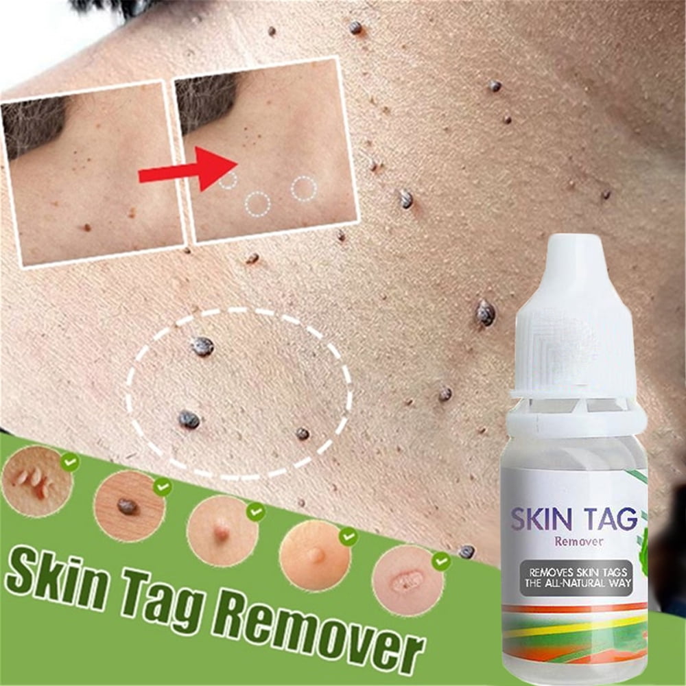 skin tag removal skin tag removal