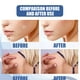 thumbnail image 4 of Seitruly Skin Set Professional Painless Warts Removing Moles Remover Labels Patch Removers Type2 NO2, 4 of 6