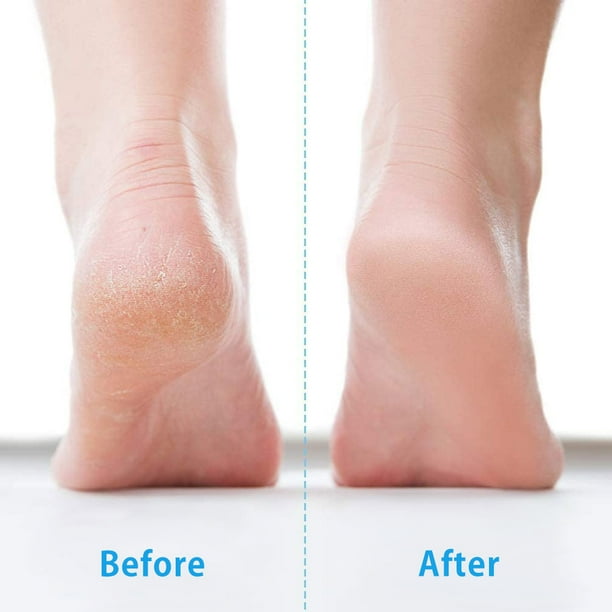 Foot cream to shop remove hard skin