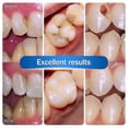 thumbnail image 3 of Teeth Resin Tooth Repair Dental Cement Cavity Filling Strong Repair Restoration, 3 of 4