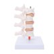 thumbnail image 5 of Modelo profesional de osteoporosis, modelo anatómico de columna vertebral humana para demostración didáctica., 5 of 14