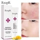 thumbnail image 1 of Crema facial para el tratamiento del acné, reparación de espinillas, Control de aceite, reduce los poros, cicatriz, hidratante, cuidado de la piel, cosméticos coreanos, cremas blanqueadoras Feliz Sencillez, 1 of 5