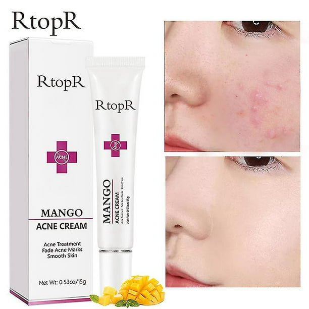 Crema facial para el tratamiento del acné, reparación de espinillas, Control de aceite, reduce los poros, cicatriz, hidratante, cuidado de la piel, cosméticos coreanos, cremas blanqueadoras kaili Sencillez