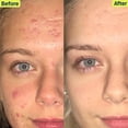 thumbnail image 4 of Kit de cuidado de la piel Acne System SLMD de Dr. Pimple Popper para 30 días y 4 piezas, 4 of 5