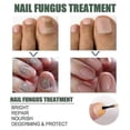 thumbnail image 2 of EELHOE Nail Repair Liquid Gray Nail Liquid Uneven Thick Nail Thickening Gray Nail Soft Nail Hand and Foot R, 2 of 4