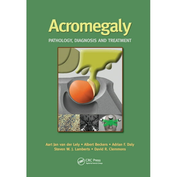 Acromegaly: Pathology, Diagnosis and Treatment, (Paperback)
